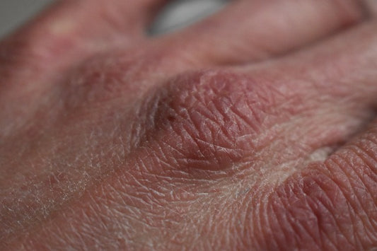 I am taking a few medicines and it is making my skin dry. What should I do?